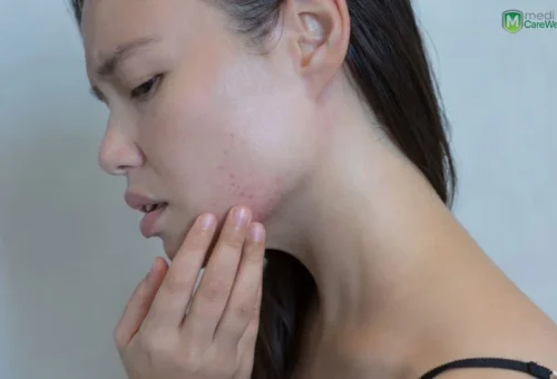 crohn's disease face