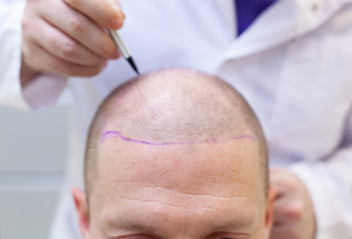 Hair transplant cost